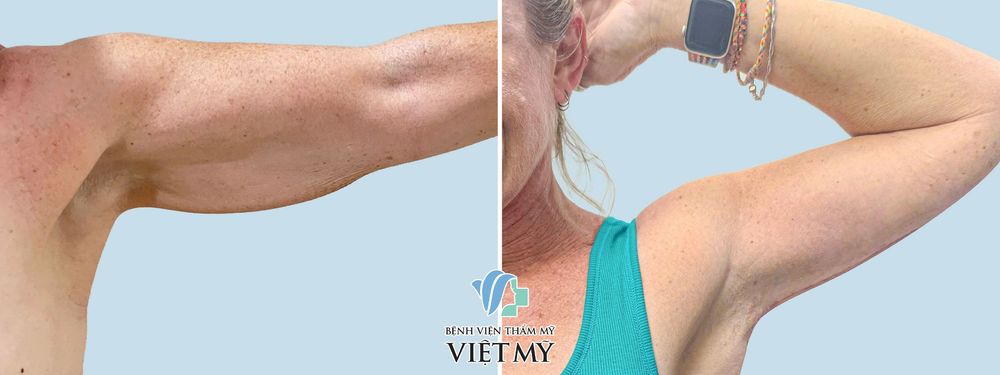 Hút mỡ căng da các vùng: cằm, tay, nách, đùi