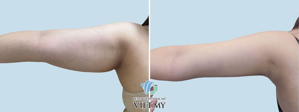 Hình ảnh trước và sau khi khách hàng hút mỡ tay.