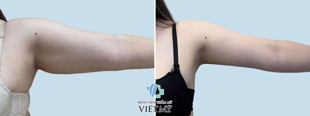 Hút mỡ căng da các vùng: cằm, tay, nách, đùi