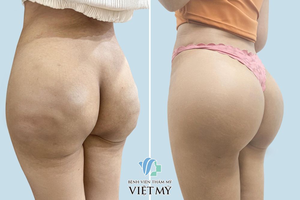 Khách hàng trước / sau khi lấy sillicon ra và nâng mông nội soi