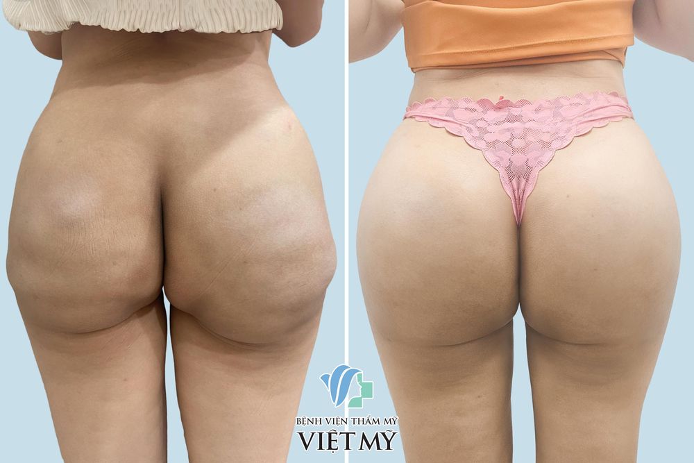 Nâng Mông Nội Soi - Độn Mông Nội Soi - bác sĩ Chiêm Quốc Thái