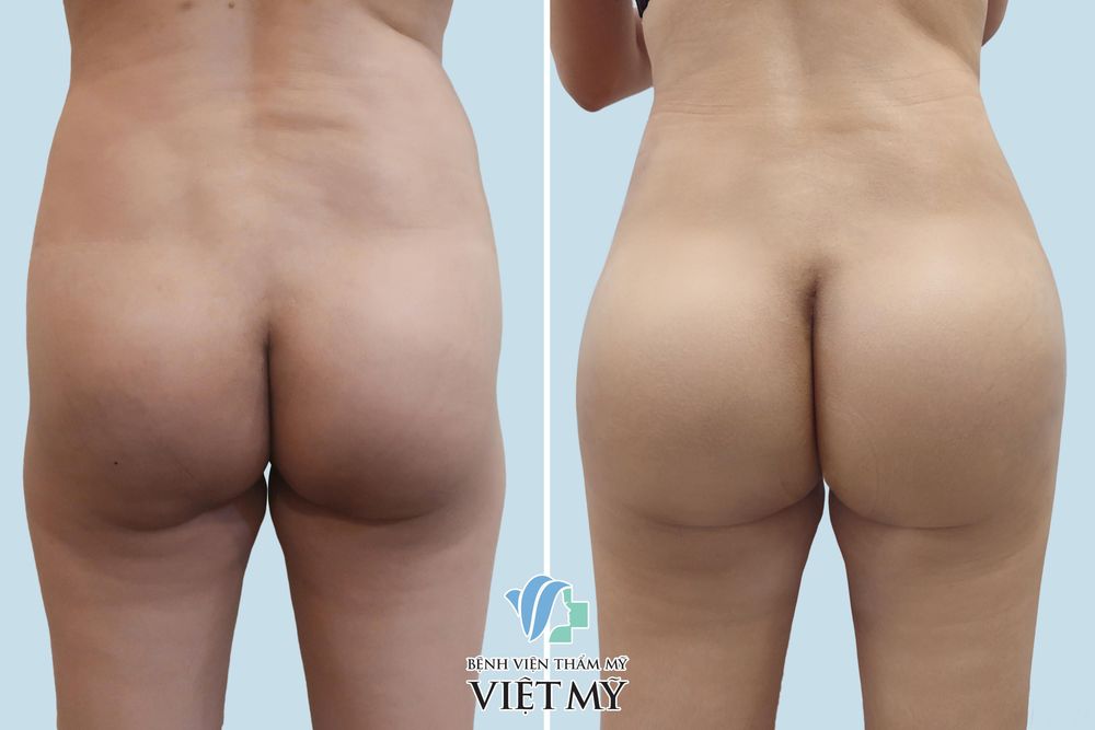 Khách hàng trước  và sau nâng mông nội soi
