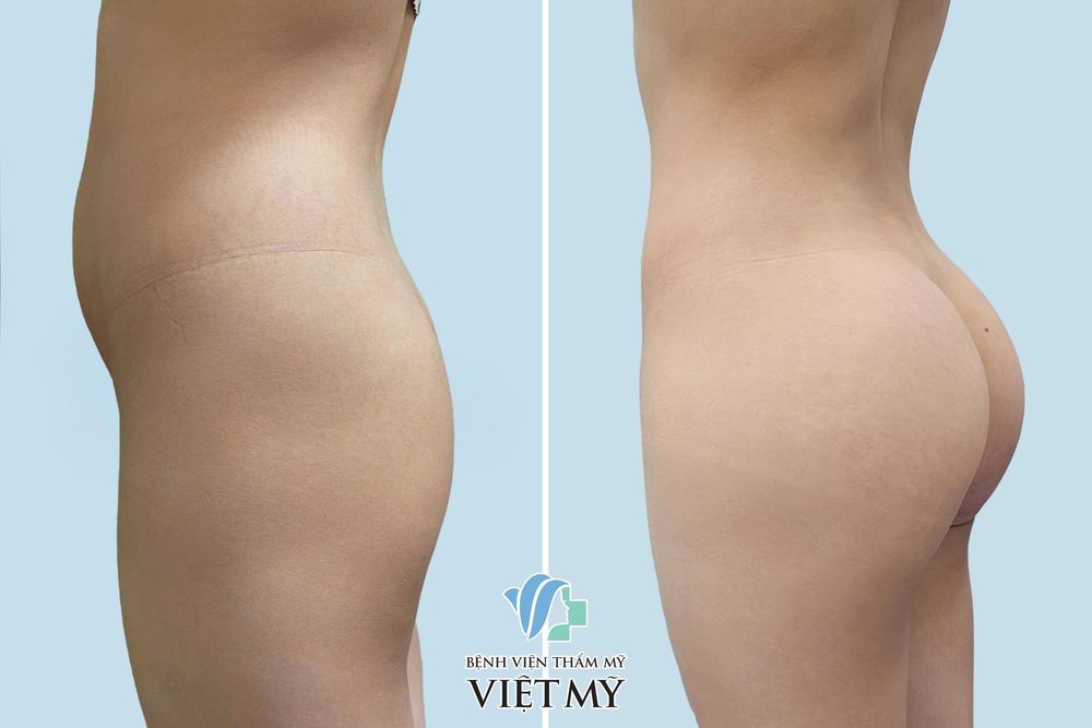 Khách hàng nam trước  và sau nâng mông nội soi