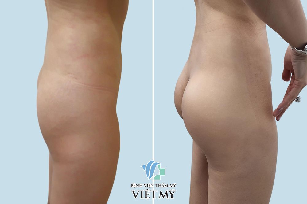 Nâng Mông Nội Soi - Độn Mông Nội Soi - bác sĩ Chiêm Quốc Thái