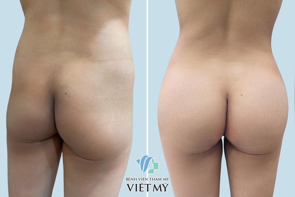 Khách hàng trước  và sau nâng mông nội soi