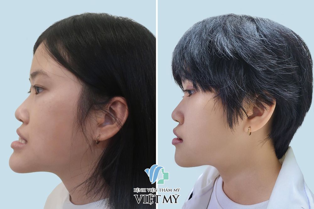 Khách hàng trước và sau tạo hình cằm vẩu