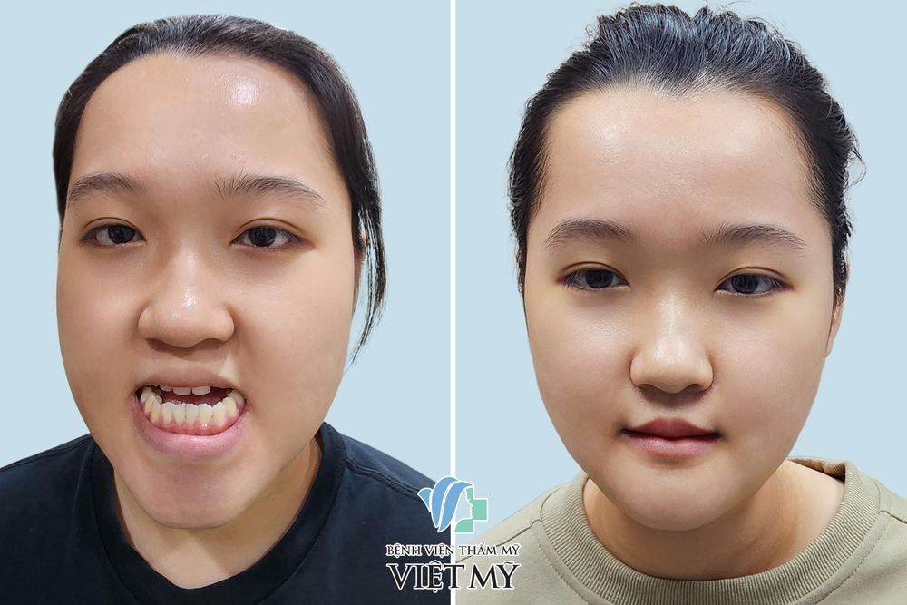 Khách hàng trước / sau tạo hình hàm móm và trượt cằm