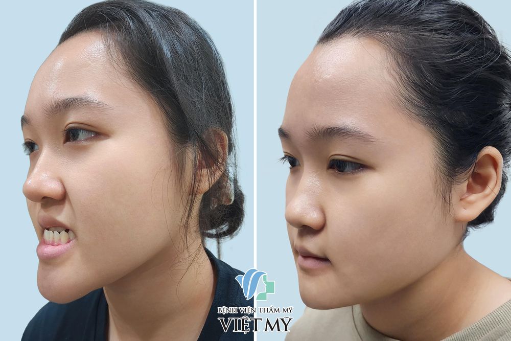 Phẫu thuật điều trị hàm móm: Giải pháp tối ưu để cải thiện chức năng và thẩm mỹ