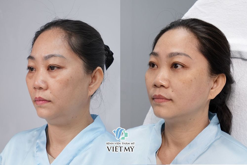 Vì sao nên thực hiện Ultherapy Prime tại bệnh viện thẩm mỹ Việt Mỹ