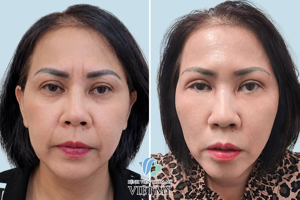Khách hàng trước sau thực hiện xóa nhăn cau mày