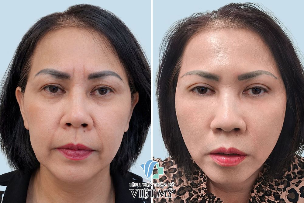 Khách hàng trước sau thực hiện xóa nhăn cau mày, làm đầy rãnh mũi má, căng da mặt, treo chân mày, cắt mí dưới