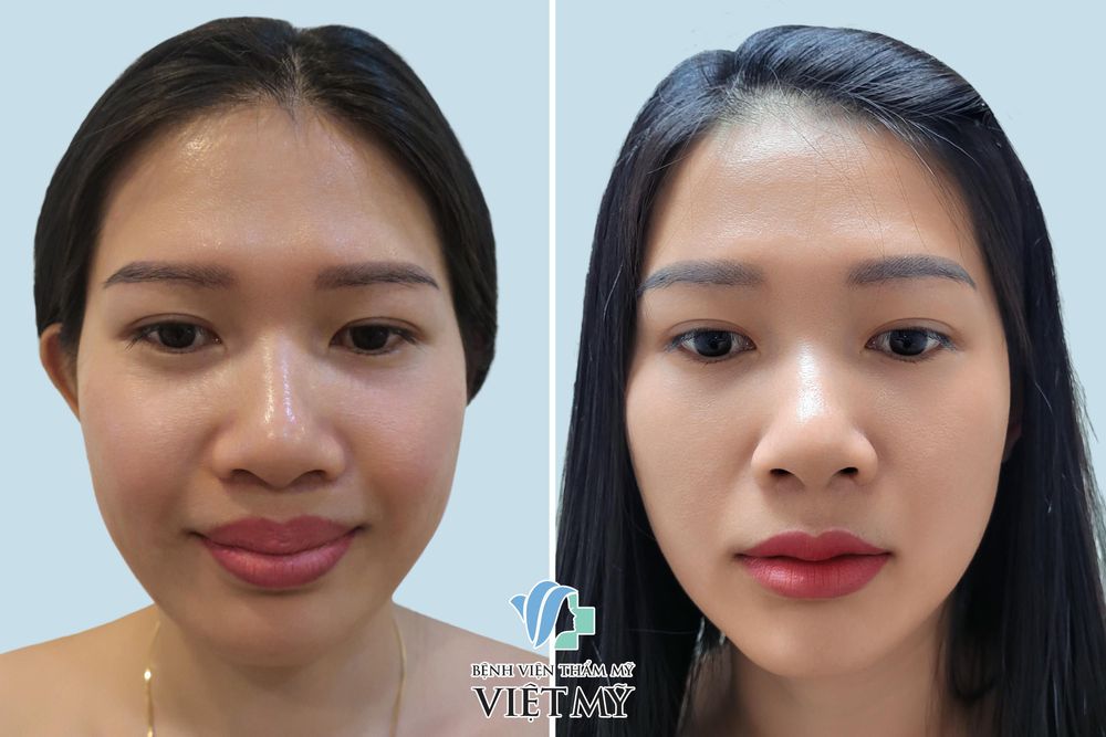 Hình ảnh khách hàng trước / sau cắt mỏng môi trên và tạo hình môi hạt lựu