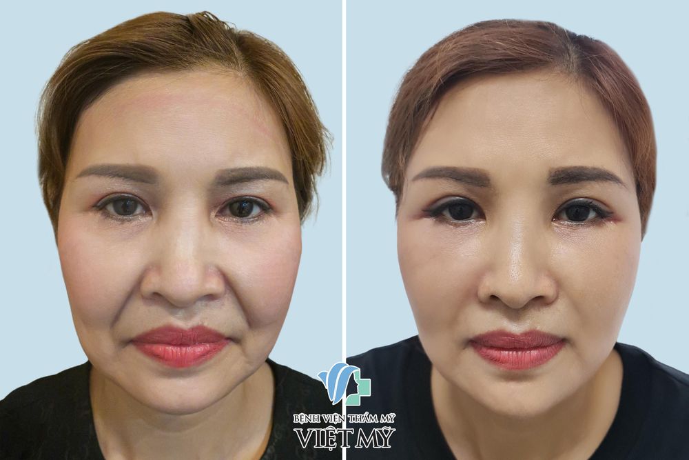Hình ảnh khách hàng trước và sau làm đầy rãnh mũi má bằng mỡ tự thân