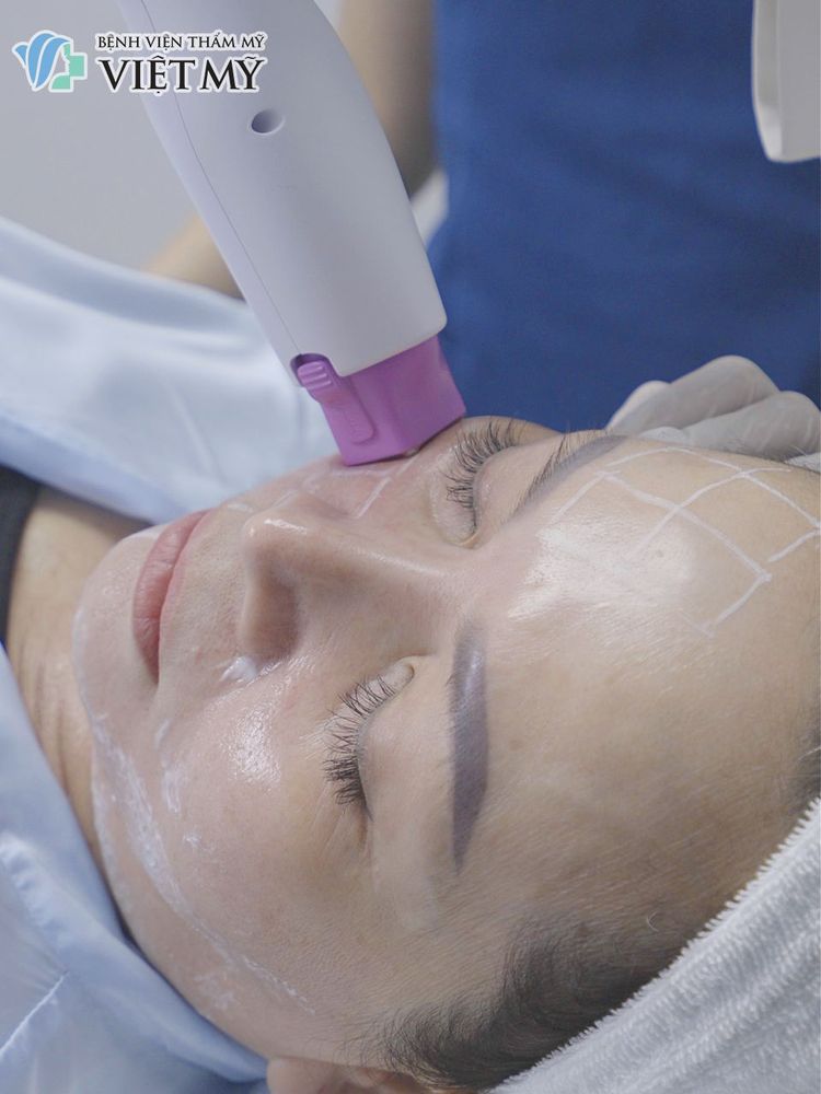 Thermage FLX giá bao nhiêu? Vì sao cùng một công nghệ nhưng chi phí lại khác nhau?