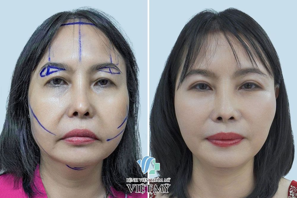 U60 căng da mặt nội soi