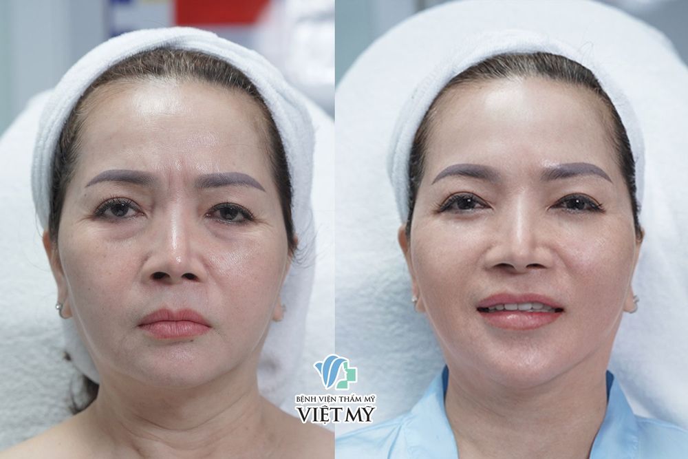THERMAGE FLX  -  Công nghệ căng da xoá nhăn, thách thức mọi làn da lão hoá