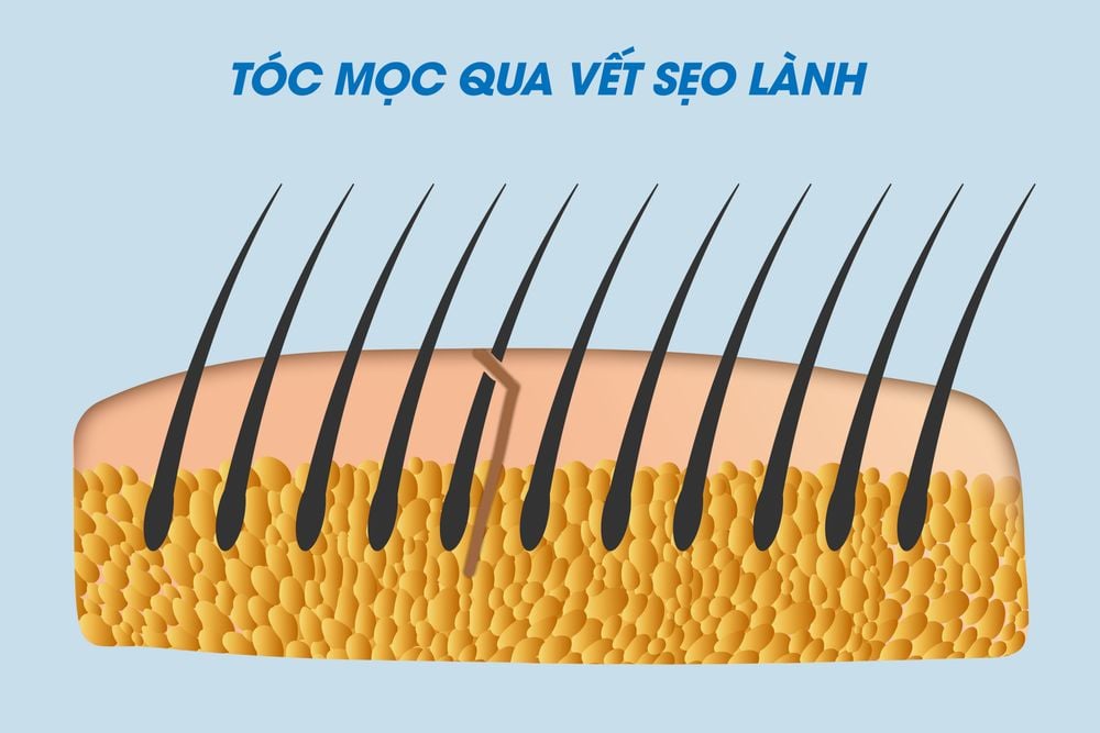 kỹ thuật khâu sẹo