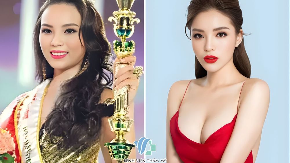 Sau khi nâng ngực, vòng 1 trở nên cân đối, đầy đặn và tự nhiên hơn