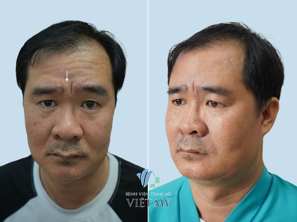 Làm đầy rãnh mũi má (rãnh cười)