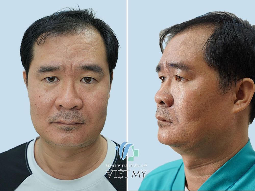Làm đầy rãnh mũi má (rãnh cười)