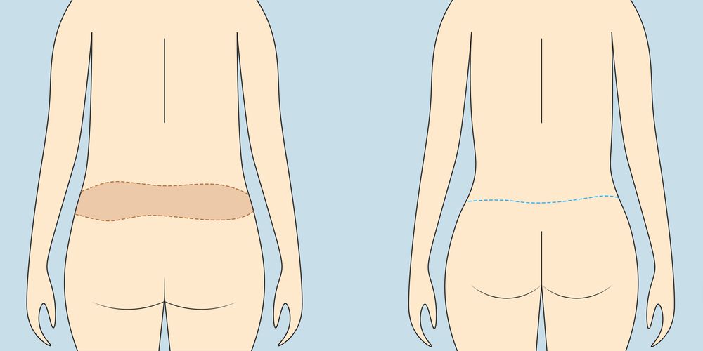 Mô phỏng phương pháp loại bỏ da thừa ở lưng dưới