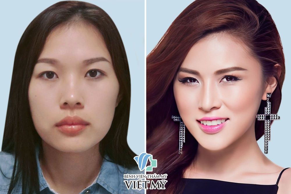 Miss Bikini Kim Yến trước và sau khi đặt mũi