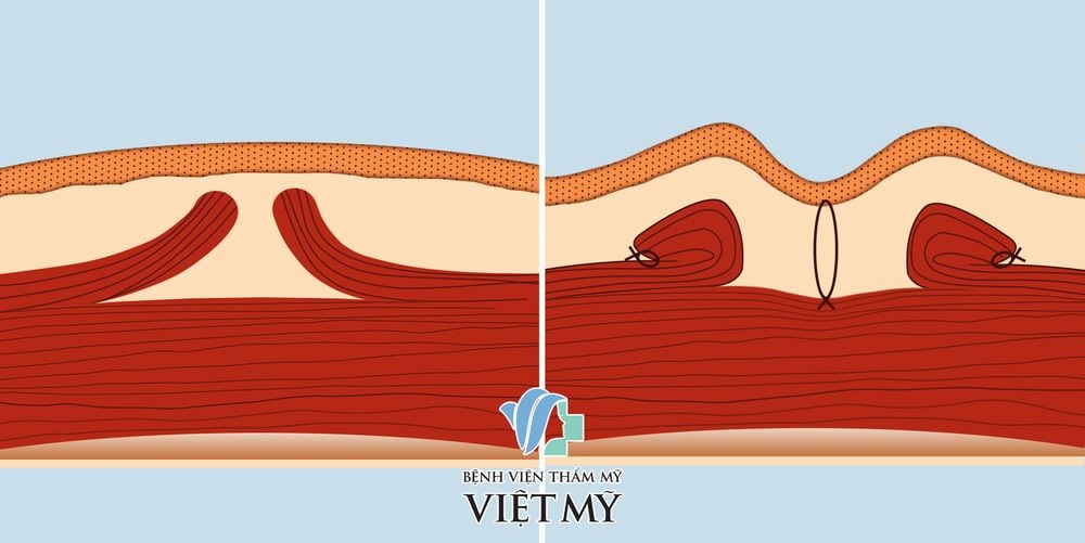 Hình ảnh mô phỏng cơ môi trên sau phẫu thuật làm sâu nhân trung