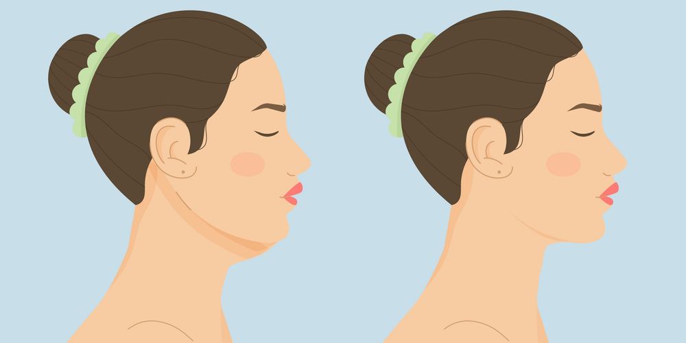 Góc cằm hàm lý tưởng của người trẻ ở quanh 95 độ