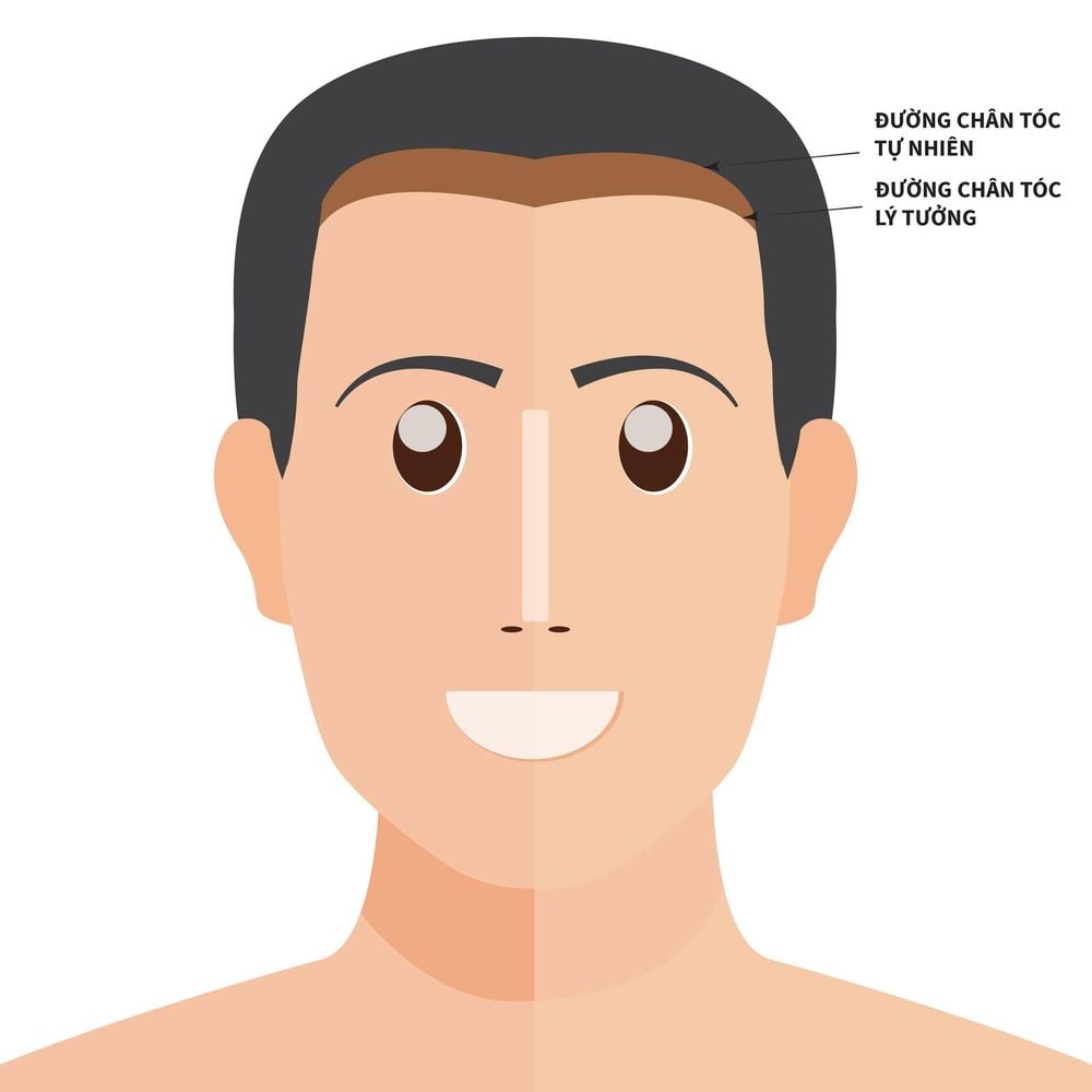 đường chân tóc tự nhiên