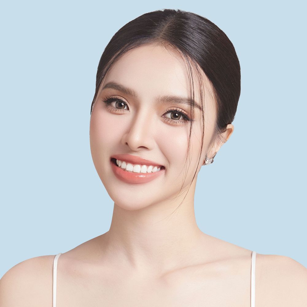 nâng môi hở lợi