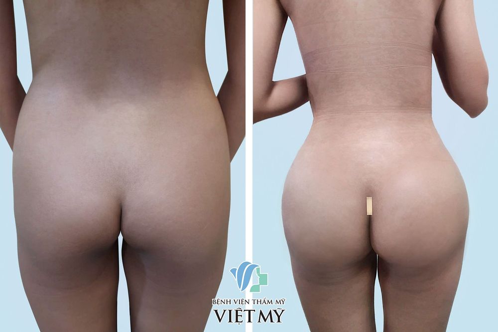 trước sau nâng mông nội soi