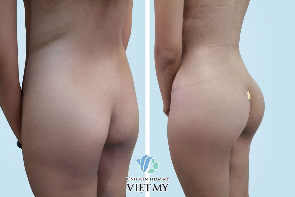hút mỡ eo nâng mông nội soi