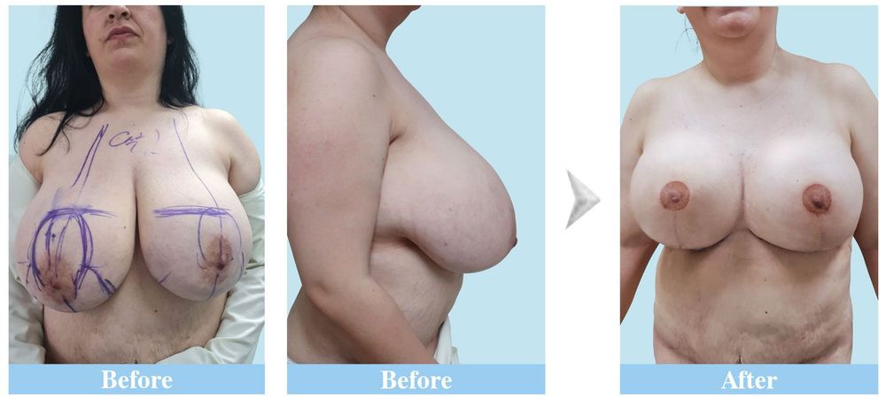 An American client after 2 weeks of undergoing breast reduction surgery.