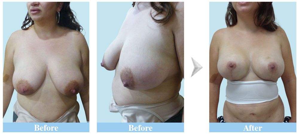 An American client after 3 weeks of undergoing sagging breasts augmentation 