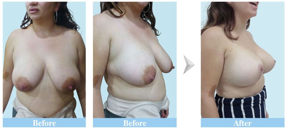 An American client after 3 weeks of undergoing sagging breasts augmentation 