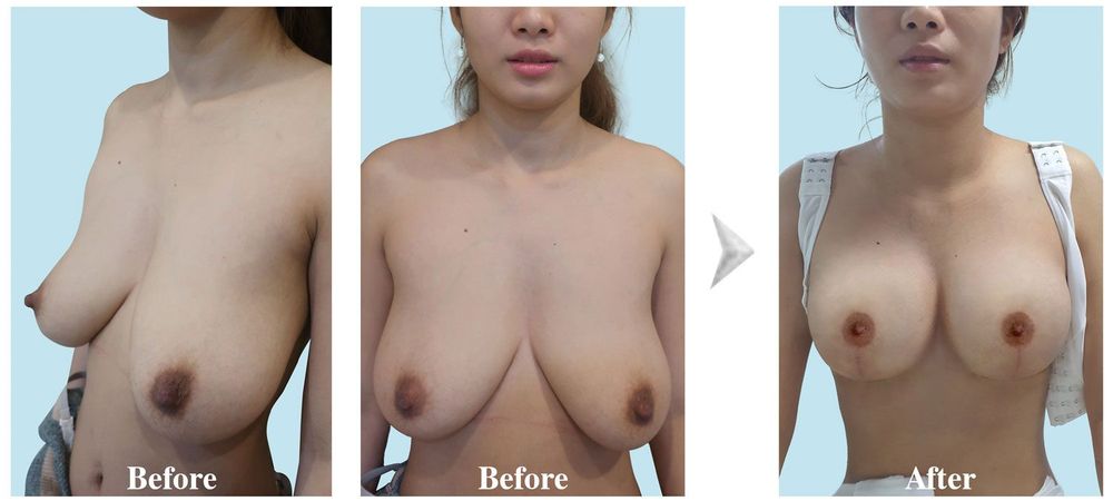 A client with level 3 sagging breasts after a month of undergoing breast augmentation and nipple reduction surgeries.