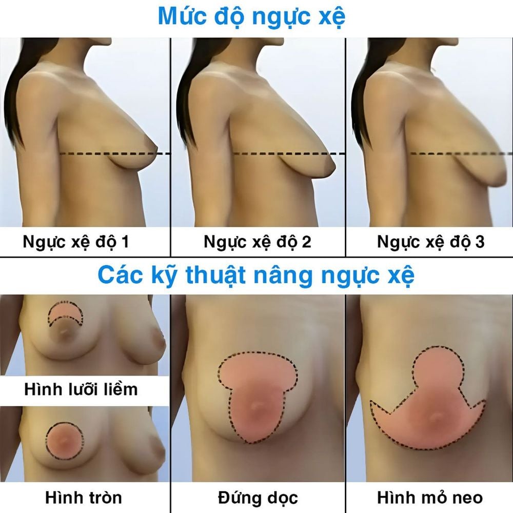 kỹ thuật nâng ngực xệ