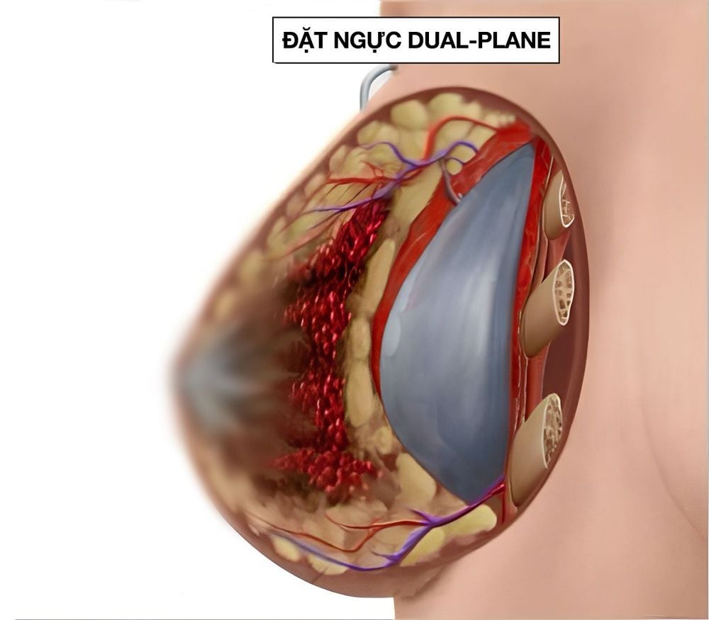 Vị trí đặt túi ngực dual plane