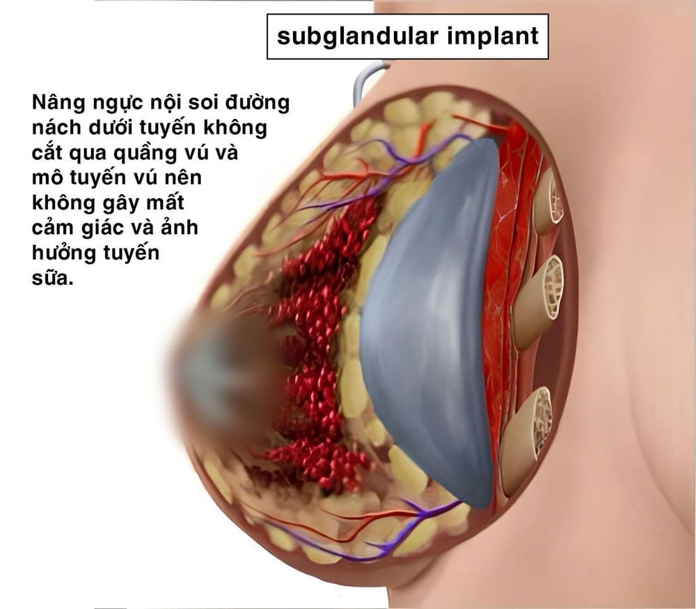 nâng ngực đường nách dưới tuyến