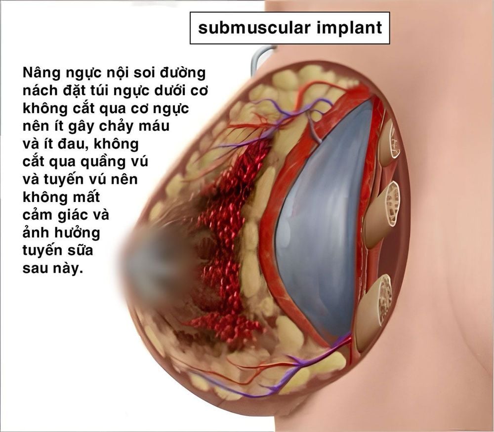 nâng ngực đường nách dưới tuyến