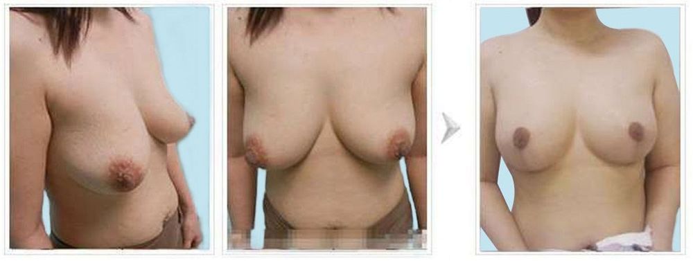 Hình ảnh trước và sau khách hàng ngực xệ độ 2 được thực hiện thu da sẹo thẳng dọc