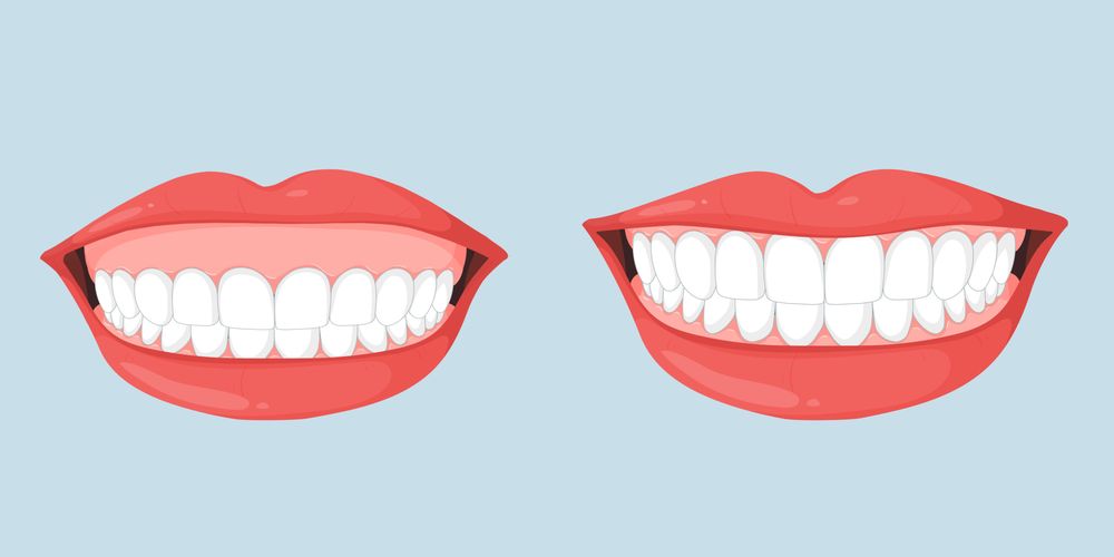 Mô phỏng lợi ích của điều trị nụ cười hở lợi