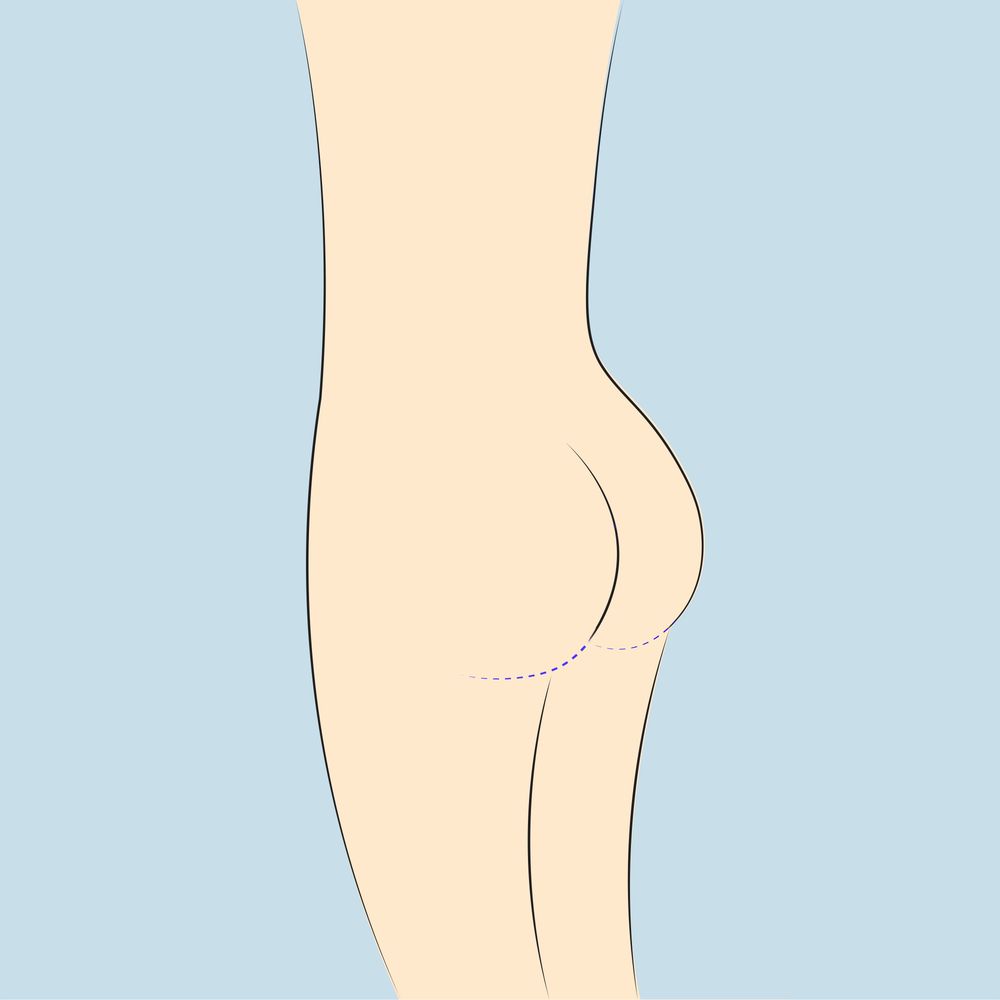 Mô phỏng đường mổ dấu sẹo nếp gấp ngang mông