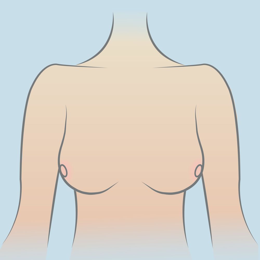 Minh họa dáng ngực đông tây, khi núm vú cách quá xa