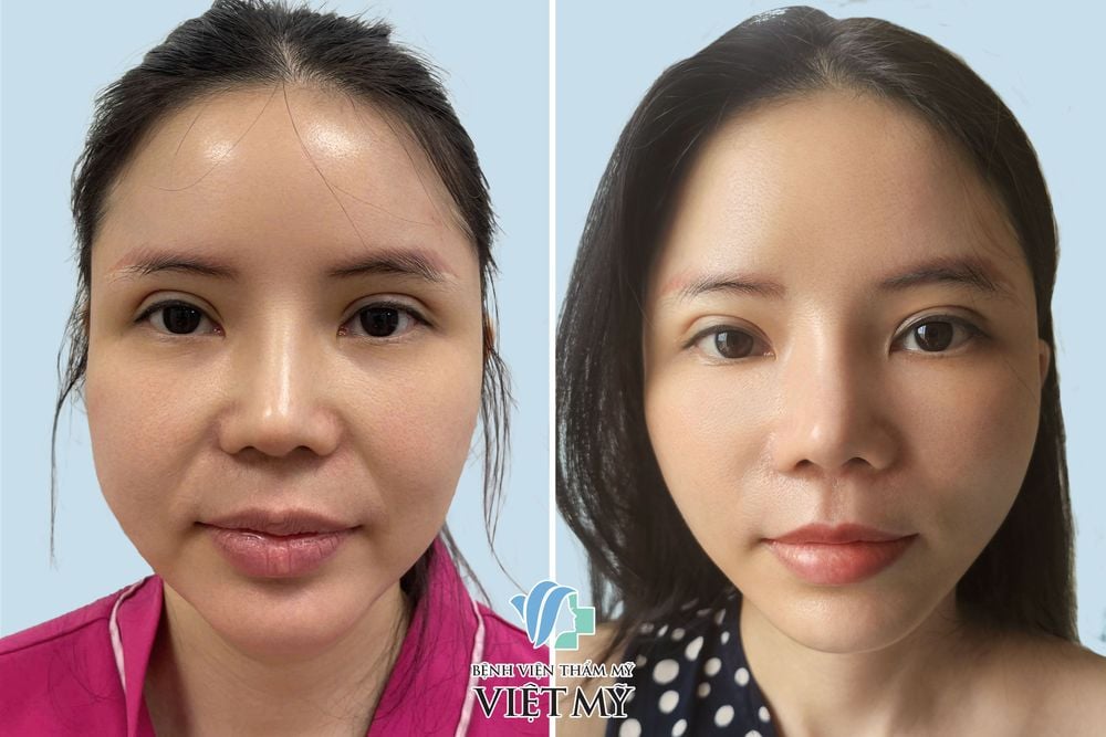 tạo hình nhân trung sâu