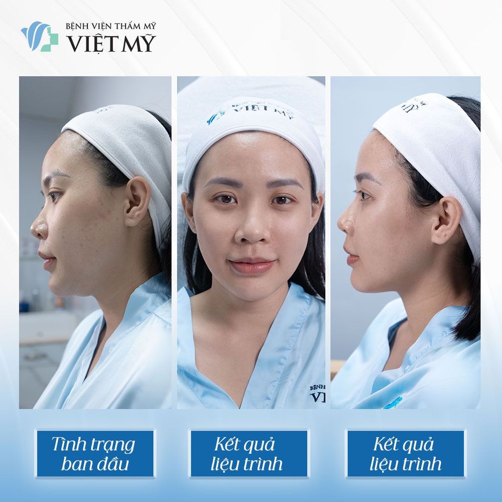 Những ai nên làm Ultherapy Prime để trẻ hóa da mặt