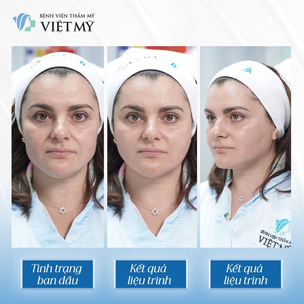 Những ai nên làm Ultherapy Prime để trẻ hóa da mặt