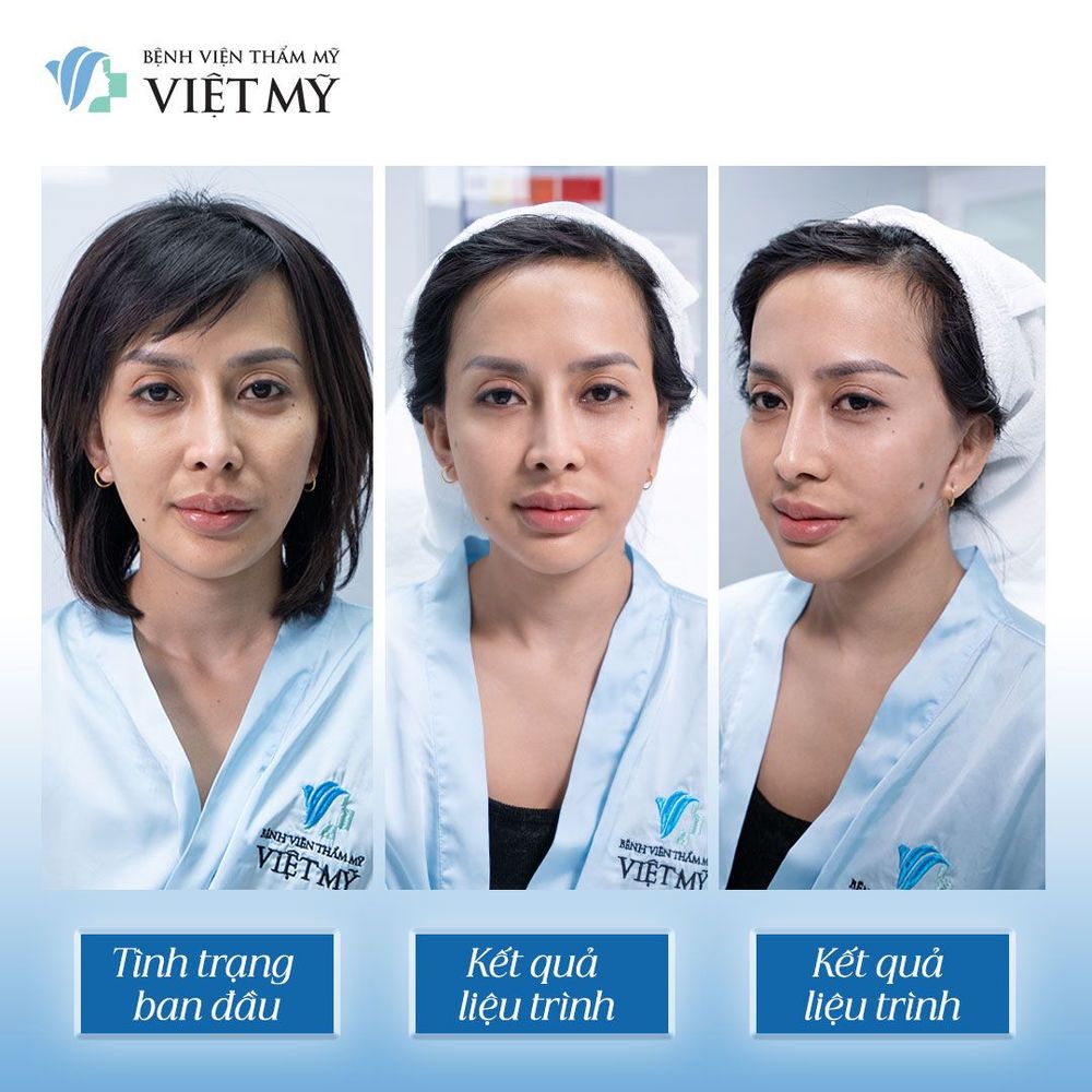 Những ai nên làm Ultherapy Prime để trẻ hóa da mặt