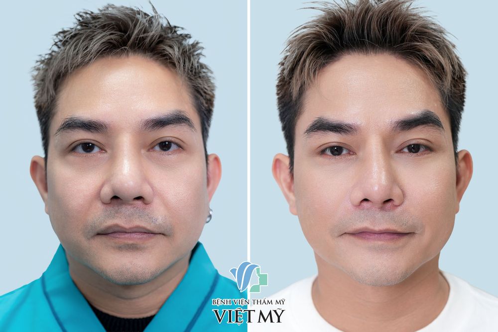 Làm đầy rãnh mũi má (rãnh cười)