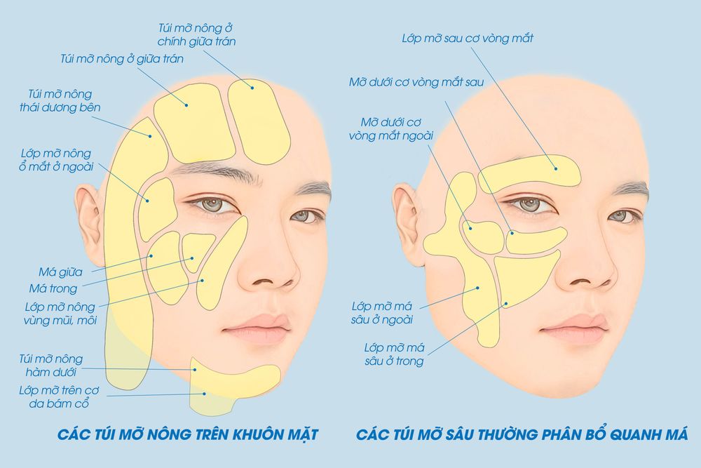 Phân bổ vị trí các túi mỡ trên khuôn mặt